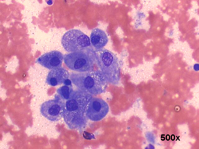 Warthins tumor (adenolymphoma), 500x M-G-G staining, loose oncocytic cells or macrophages?