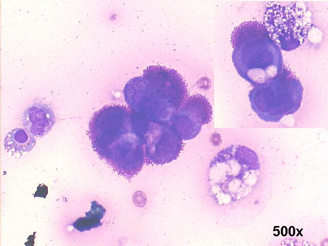 Papillary carcinoma of ovary, 500x M-G-G staining, many cells with microvilli, in the inset a window between cells