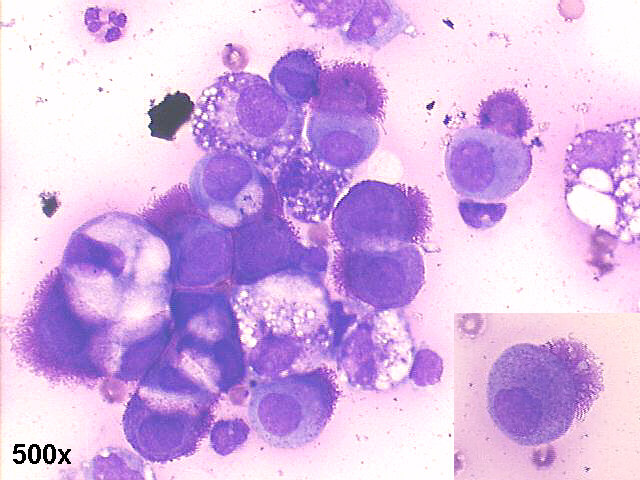 Papillary carcinoma of ovary, 500x M-G-G staining, many anemone cells with microvilli, some windows between cells