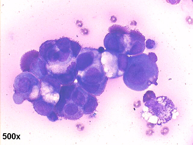 Papillary carcinoma of ovary, 500x M-G-G staining, many cells with microvilli