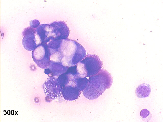 Papillary carcinoma of ovary, 500x M-G-G staining, many anemone cells with microvilli