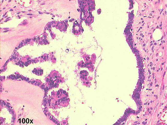 100x H&E staining, many cells with microvilli