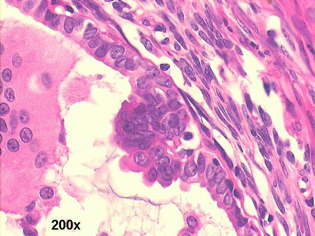 200x H&E staining, many cells with microvilli