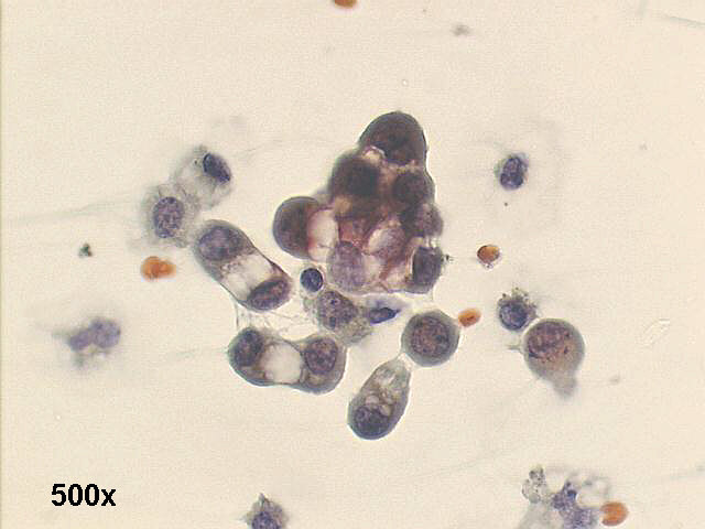 Ascites cytopathology: 500x oil Pap staining, very ostensive windows between the cells
