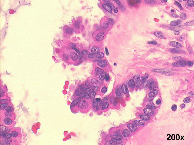 200x H&E staining, many cells with microvilli