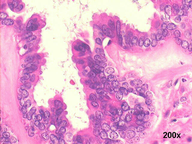 200x H&E staining, many cells with microvilli