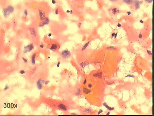 500x Pap staining: keratinized squamous cells