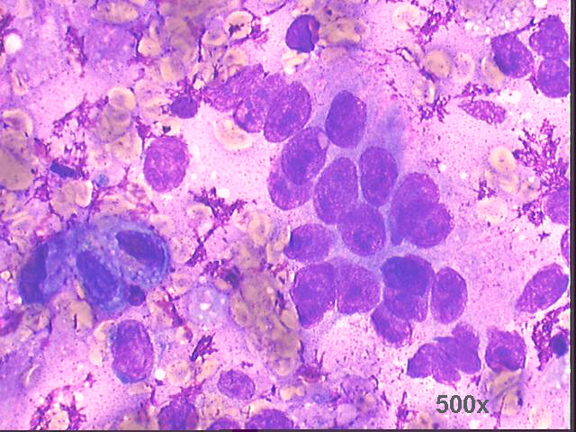 high power view of previous image 500x M-G-G staining