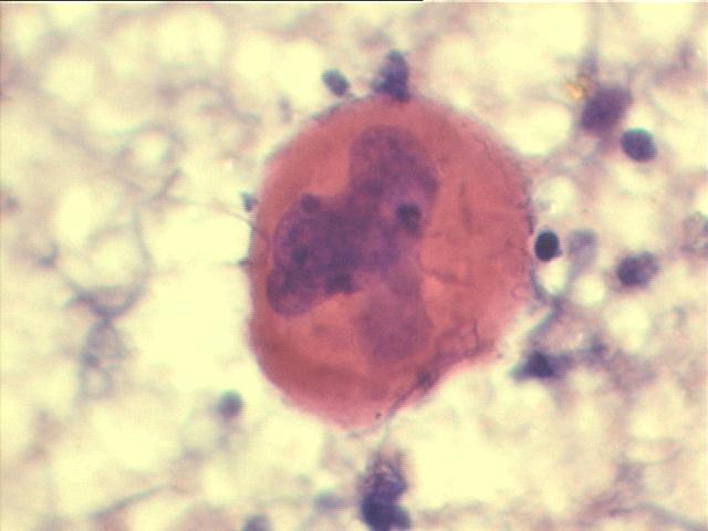 Papanicolaou staining, 1,000x, another megakaryocyte