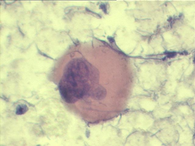 Extramedullary hematopoiesis, Papanicolaou staining, 1,000x, typical image of megakaryocyte