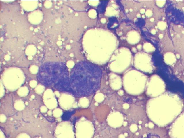Extramedullary hematopoiesis, M-G-G staining, 1,000x, another lobulated naked nucleus of megakaryocyte