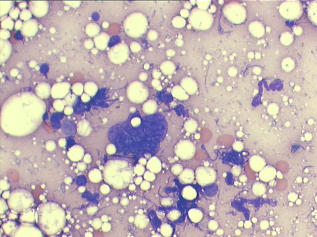 Extramedullary hematopoiesis, M-G-G staining, 500x, naked polylobulated nucleus of megakaryocyte