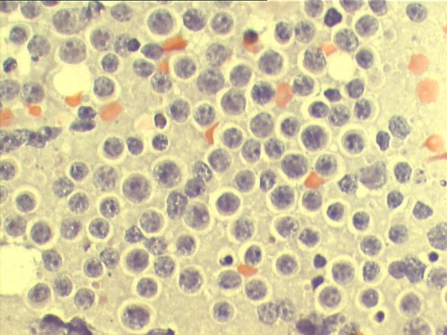 Papanicolaou staining, 500x, large lymphoid cells with clumped chromatin