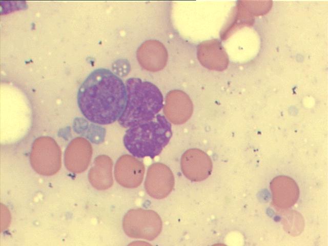 B-cell lymphoma M-G-G staining, 1,000x, large lymphoid cells (lymphoblasts) and some pale blue lymphoglandular bodies