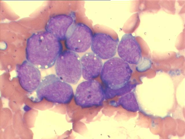 B-cell lymphoma, large lymphoid cells, M-G-G staining, 1,000x,