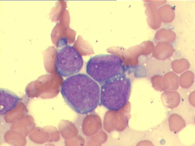 M-G-G, 1,000x, large lymphoid cells, with ostensive nucleoli