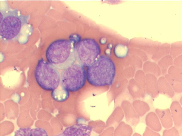 M-G-G staining, 1,000x, large lymphoblasts, with ostensive nucleoli