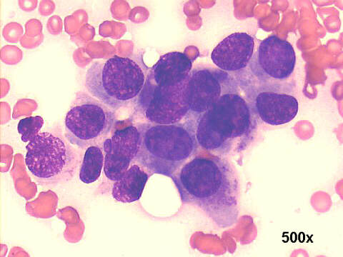 500x M-G-G staining, definitely larger malignant cells