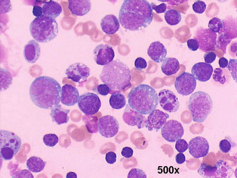 500x M-G-G staining, plasmablasts, apoptotic cells