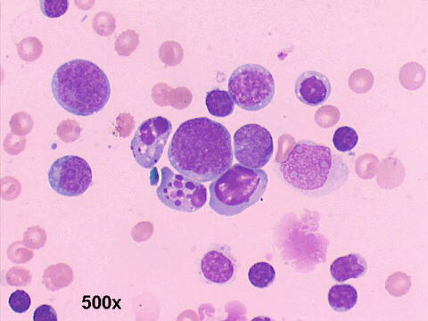 500x M-G-G staining, plasmablasts, apoptotic cells