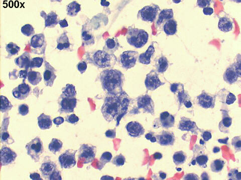 500x Papanicolaou staining, plasmablasts, apoptotic cells