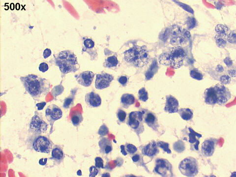 500x Papanicolaou staining, plasmablasts, apoptotic cells