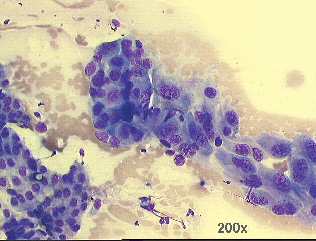 200x M-G-G staining - another group of glandular cells, with morphology suggestive of malignancy.