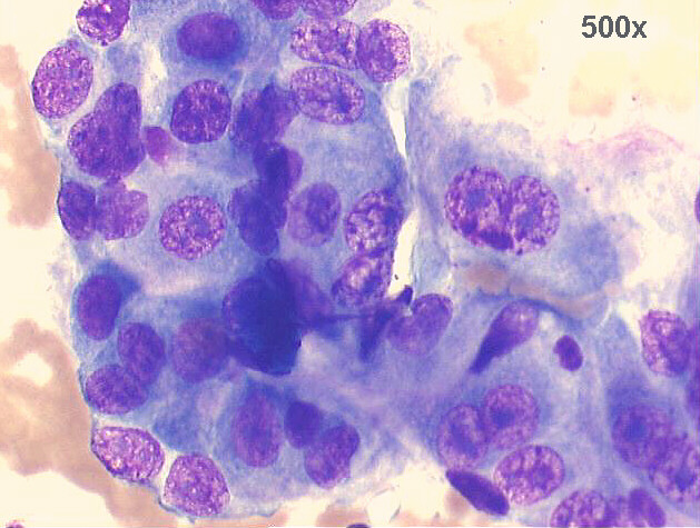 500x M-G-G staining, high power view of previous image; the nuclear abnormalities are obvious, with chromatin clumping and large irregular nucleoli