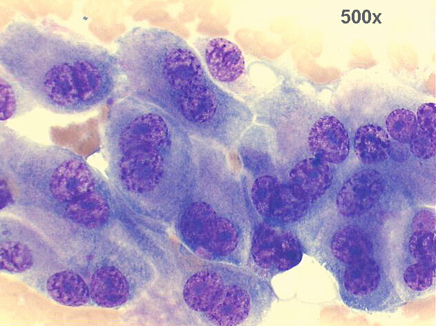 500x M-G-G staining, another high power view of same previous image
