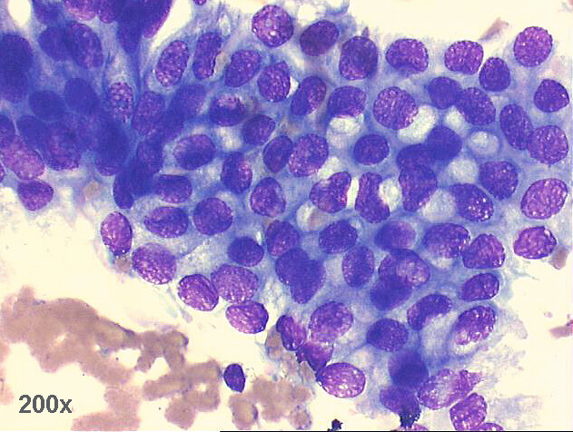 500x M-G-G staining - another group of columnar and goblet cells, with benign morphology.