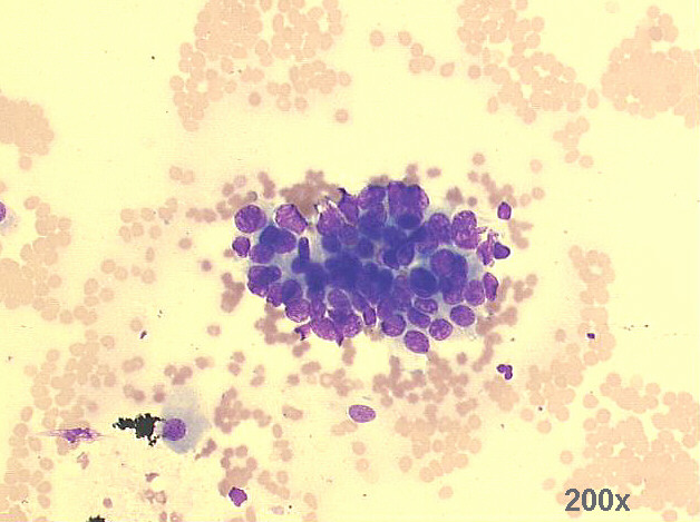 200x M-G-G staining - group of glandular cells, with morphology suggestive of malignancy.