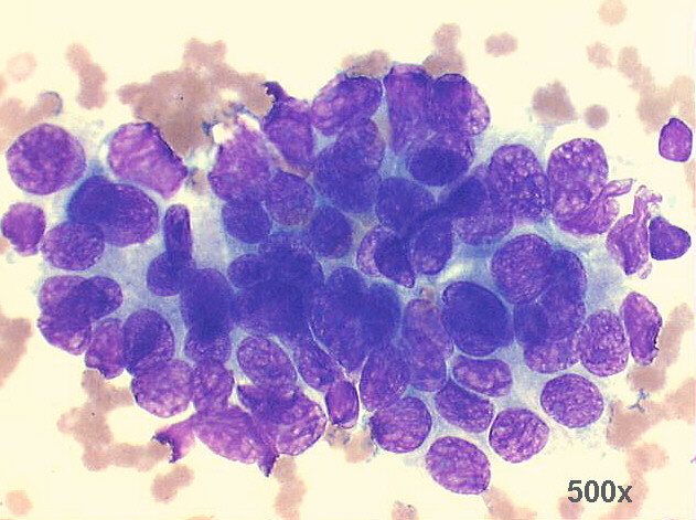 500x M-G-G staining, high power view of previous image: malignant looking cells, with crowding, hyperchromasia and anisonucleosis