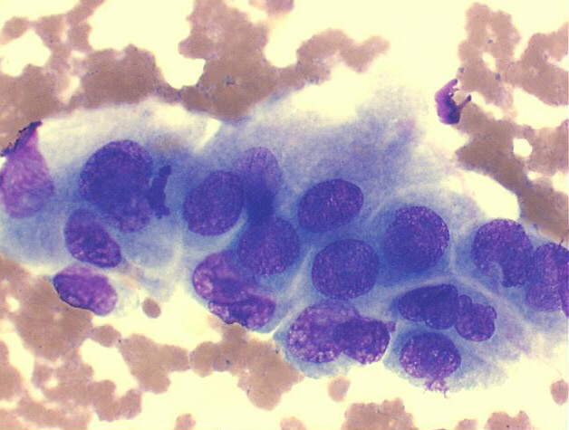 500x M-G-G staining - another high power view: malignant looking cells, with crowding, hyperchromasia and anisonucleosis.