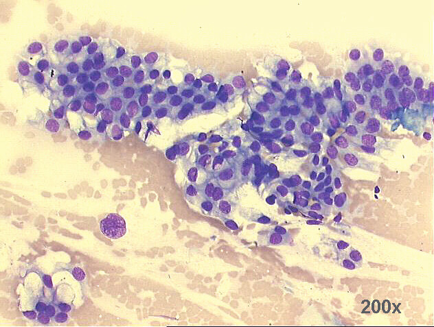 200x M-G-G staining - low power view of groups of columnar and goblet cells, with benign morphology. Notice a very large naked nucleus.