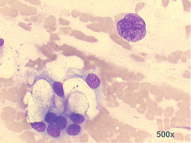 500x M-G-G staining, high power view of previous image: detail of the large naked nucleus, very suspicious of malignancy