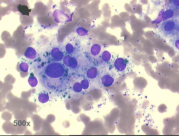 500x M-G-G staining, group of hepatocytes with marked anisocytosis and anisonucleosis, obvious bile pigment staining