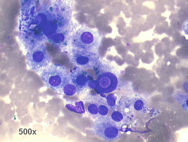500x M-G-G staining, group of hepatocytes with marked anisocytosis and anisonucleosis, one large nucleus with intranuclear cytoplasmic inclusion, obvious bile pigment staining