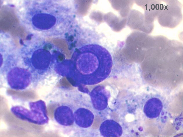 1,000x M-G-G staining, high power view of previous image