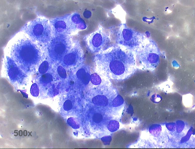 500x M-G-G staining, group of hepatocytes with marked anisocytosis and anisonucleosis, less bile pigment staining