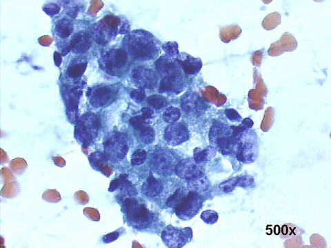 Papanicolaou staining: honeycomb pattern is lost.