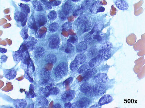 High power view, Papanicolaou staining: overlapping nuclei protruding from the periphery of the cell clusters (feathering)