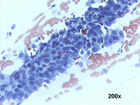 Papanicolaou staining: tightly crowded sheet with overlapping nuclei,  the cluster has 'ragged edged' borders
