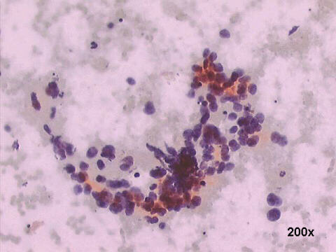 200x Papanicolaou staining, smudging and nuclear debris (blue bodies)