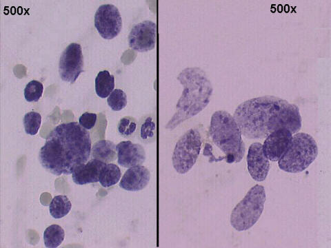 500x Papanicolaou staining, salt and pepper chromatin