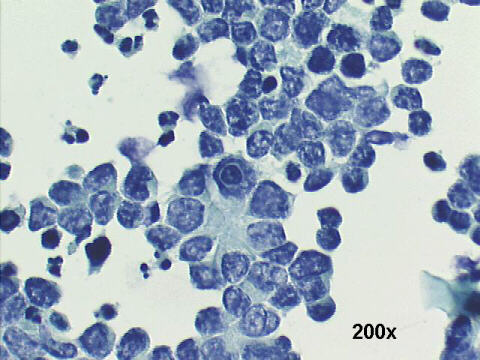 200x Papanicolaou staining - see rosettelike formation