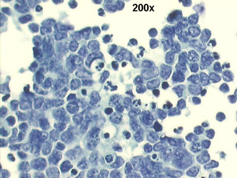 200x Papanicolaou staining - many apoptotic bodies