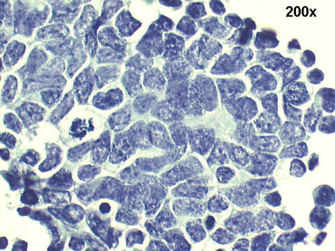 200x Papanicolaou staining - conspicuous nuclear molding