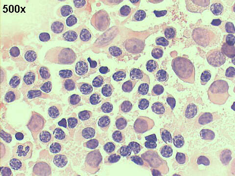 500x Papanicolaou staining, numerous lymphocytes, isolated malignant cells