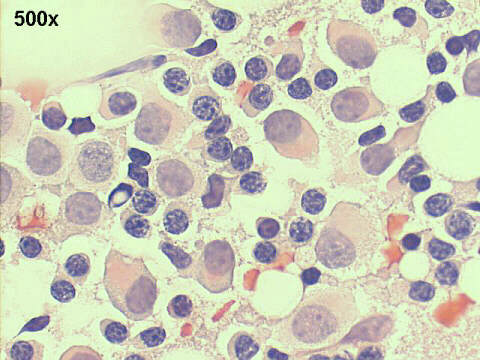 500x Papanicolaou staining, isolated malignant cells, lymphocytes and plasma cells
