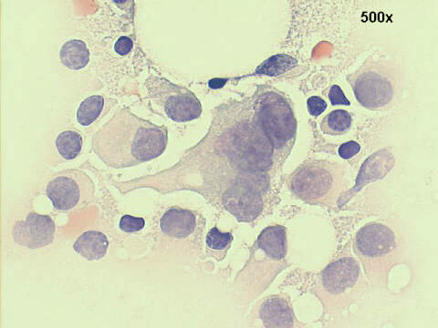 500x Papanicolaou staining, large multinucleated malignant cell